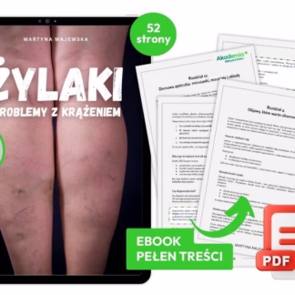 Żylaki i problemy z krążeniem